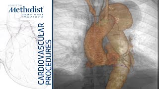 Image Fusion of Feraheme MRA for Thoracic Aortic Endograft Placement Lumsden MD Chinnadurai MBBS [upl. by Sharline464]