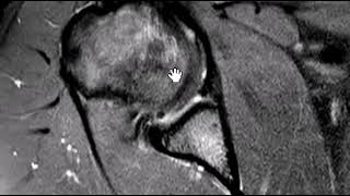 SLAP tear with fibroosseous Bankart lesion [upl. by Nomde]