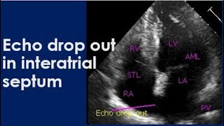 Echo drop out in interatrial septum [upl. by Aridnere]