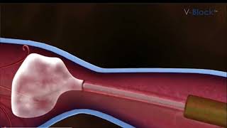 Treatment of large saphenous veins using the VBlock procedure [upl. by Papke532]