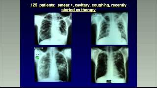 Tuberculosis – Global Scenario amp End TB Strategy [upl. by Mackie]