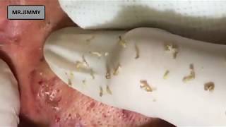 OLD AGE BLACKHEAD REMOVAL [upl. by Yren]