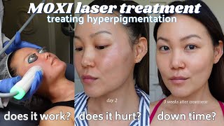 IS IT WORTH IT MOXI Laser Treatment for hyperpigmentation skin texture collagen production [upl. by Els]