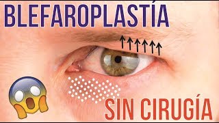 BLEFAROPLASTÍA SIN CIRUGÍA MEDIANTE LASER CO2 FRACCIONADO 💕 DR ALBERTO CALVO QUIROZ [upl. by Adalard]