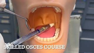 inferior alveolar nerve block technique by Sarah Hussein [upl. by Aihsa929]