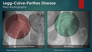 LeggCalvePerthes Disease Plain Radiography [upl. by Trauts271]