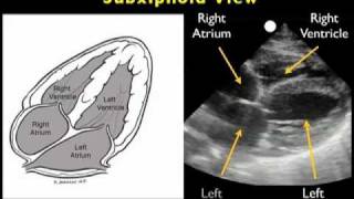 How to Echocardiography  Subxiphoid View [upl. by Xineohp]