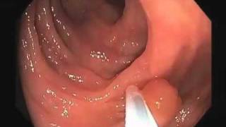 Colonoscopy Video Tour Removal of a Colon Polyp Polypectomy [upl. by Hoang]