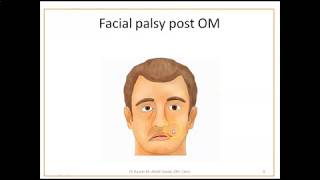 Complications of Otitis Media 2 Mastoiditis and facial palsy [upl. by Mufi226]