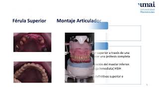 Rehabilitación implantoprotésica con carga inmediata en maxilar inferior [upl. by Aivizt922]