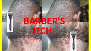 BARBERS ITCH WHY THE ITCH [upl. by Evannia728]