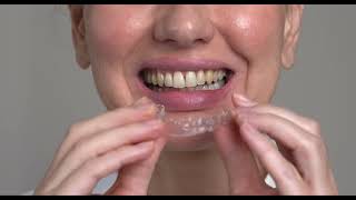 Invisalign® and Other Clear Aligners [upl. by Adnalro589]