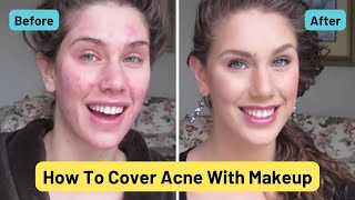 Foundation Routine For Acne  How To Cover Pimples Scars Cystic Acne Blackheads amp Oil [upl. by Calvinna]