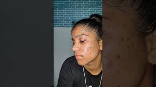 tretinoin cream usp 0025 acne journey only 15 days treatment is going on tretinoincream [upl. by Yrmac655]