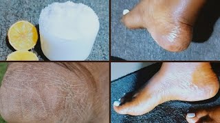 GET Rid of Dead Skin on your Feet FAST with Kitchen Ingredients [upl. by Sellig165]