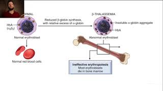 7beta thalassemie [upl. by Akym]