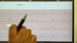 Analyzing an AtrioVentricular AV Heart Block and an Irregularly irregular Rhythm [upl. by Champaigne]