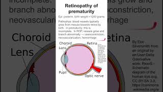 Retinopathy of prematurity [upl. by Naquin]