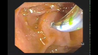 Large CBD stone  Biliary stenting [upl. by Ahseen229]