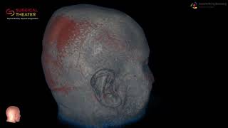 Resection of Brain Stem Cavernoma Minimally Invasive Surgery [upl. by Etteb]