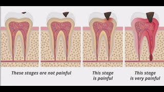 Stages of Tooth Decay Introduction [upl. by Blumenfeld]