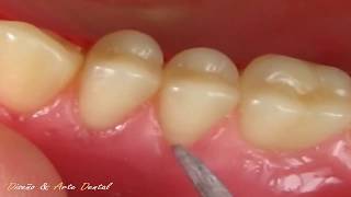 3  🔴 DEFINICIÓN DE CUELLOS 🔴 en Protesis total dental ARMONIA [upl. by Bardo]