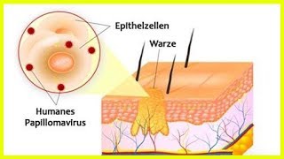 Warum entstehen Warzen [upl. by Soelch]