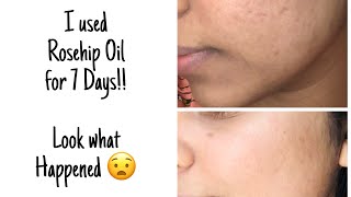 I used Rosehip Oil for 7 Days😧 [upl. by Lrat]