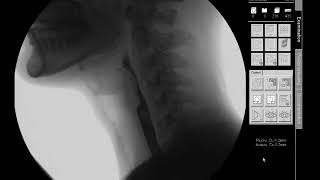 Nectar Thick Liquids  Modified Barium Swallow Study MBSS Lateral View HD [upl. by Maffa960]