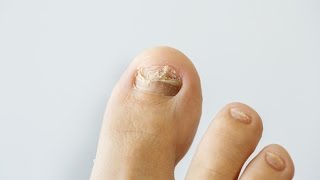 How to prevent and treat nail fungus [upl. by Galen]