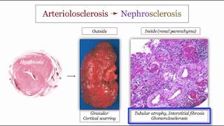 12DaysinMarch Blood Pressure IV Hypertensive Nephrosclerosis for the USMLE Step One Exam [upl. by Zonnya694]