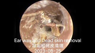 Ear wax and Dead skin removal耳垢和死皮清理20230825 [upl. by Atekram]