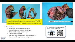 Pancreas Mucinous cystic neoplasm Gross pathology [upl. by Rodina191]