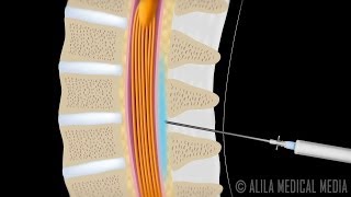 Lumbar Epidural Steroid Injection Animation [upl. by Boyce101]