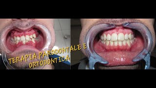 Periodontal and Orthodontic Therapy [upl. by Janyte]