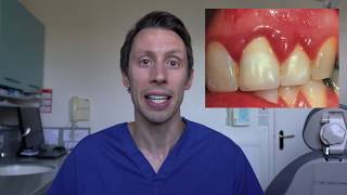 A patients guide to gum disease amp interdental cleaning [upl. by Nastassia205]