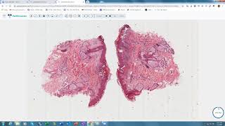 Lecture 5Intraepidermal Vesiculobullous Disorders [upl. by Ecidna]