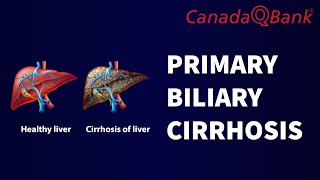 Primary Biliary Cirrhosis [upl. by Esile]