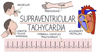 Understanding Supraventricular Tachycardia SVT [upl. by Severen]