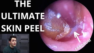 The Ultimate Skin Peel Dead Skin Lifted From Trapped Eardrum [upl. by Etiuqram]