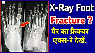 How to read Foot Fracture XRay  Metatarsal Fracture  1st Metatarsal Base  UdayXray [upl. by Amikehs178]