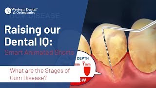 What are the Stages of Gum Disease  Western Dental [upl. by Yojenitsirk]