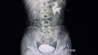 kidney stones nephrolithiasis kidneystones calcium renalcolic lumbarpain flank trendingreel [upl. by Yllak]