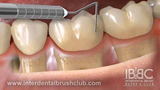 WHY IS INTERDENTAL BRUSHING SO IMPORTANT AFTER POCKET REDUCTION GUM SUGERYmp4 [upl. by Ocire772]