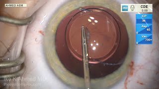 Congenital Posterior Polar Cataract Detailed Surgical Technique [upl. by Githens]