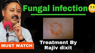 Ayurvedic Fungal infection Treatment By Rajiv dixit [upl. by Adnohrahs]