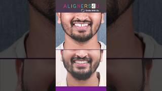 Clear Choice Clear Smile  Invisible Aligners Journey  Braces  Hyderabad  Aligners4u  Teeth Gap [upl. by Ailatan]