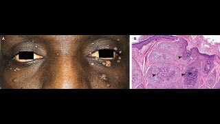 Molluscum contagiosum [upl. by Ahcorb]