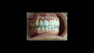 gingivectomyoralsurgeryperiodontalsurgery [upl. by Smail567]