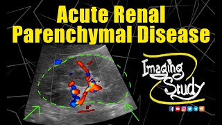 Acute Renal Parenchymal Disease  Ultrasound  Case 181 [upl. by Hesketh443]